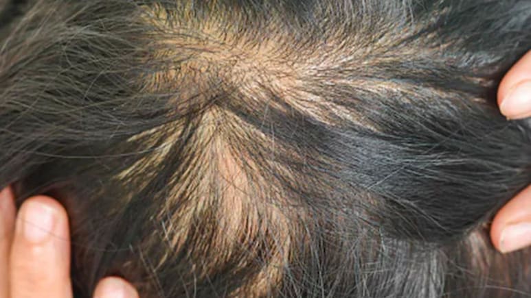 Hair Fall रोकने के लिए सिर्फ शैंपू-तेल काफी नहीं, जानिए हेयर फॉल कंट्रोल के लिए Scalp Care क्यों है जरूरी