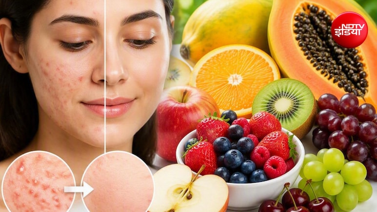 फोड़े-फुंसी हटाने के लिए कौन सा फल खाएं? 5 फ्रूट्स, जिनसे त्वचा हो सकती है साफ
