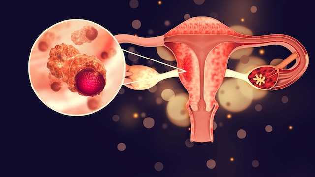 Endometrial Cancer Awareness: Know The Signs, Know The Risks