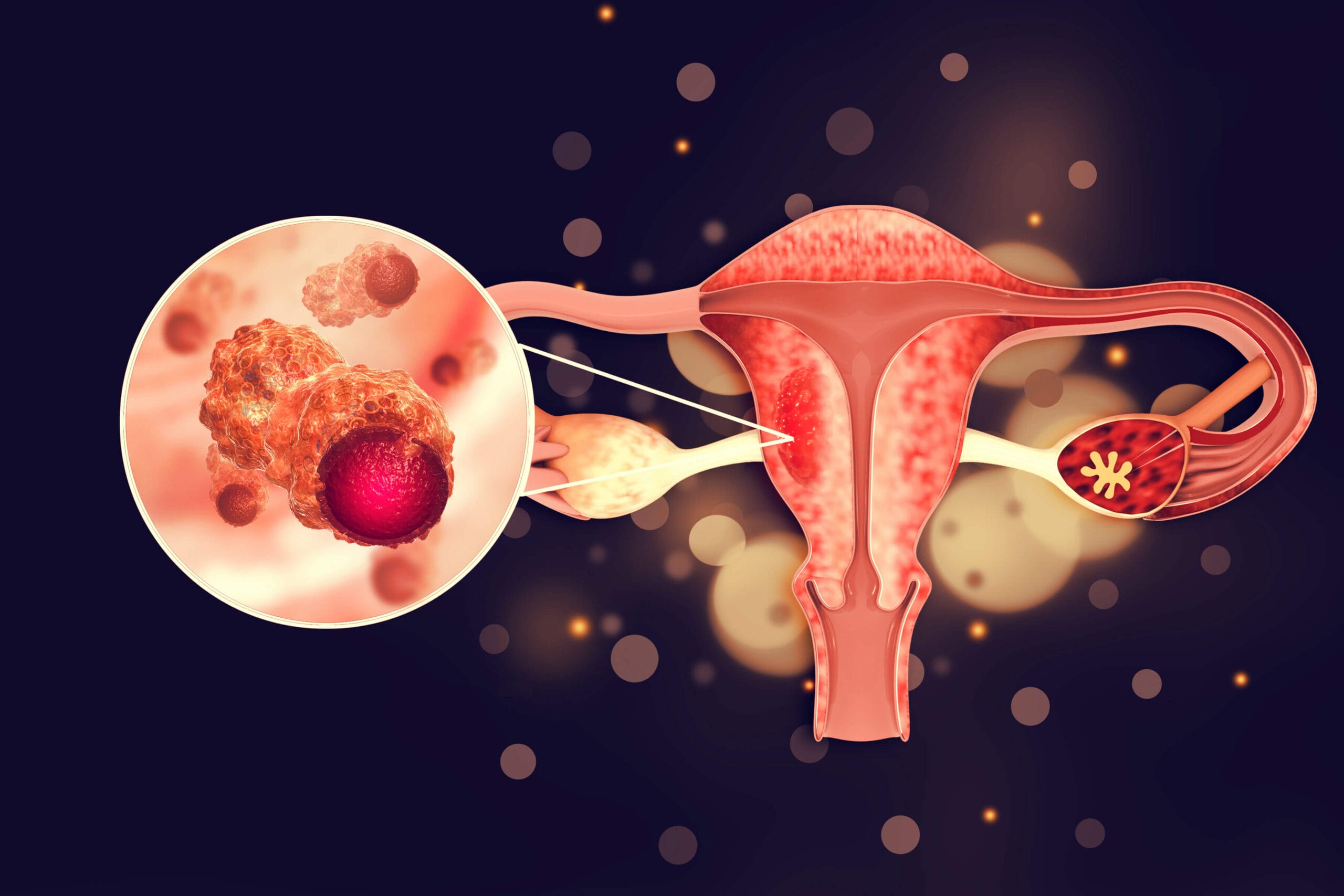 Endometrial Cancer Awareness: Know The Signs, Know The Risks