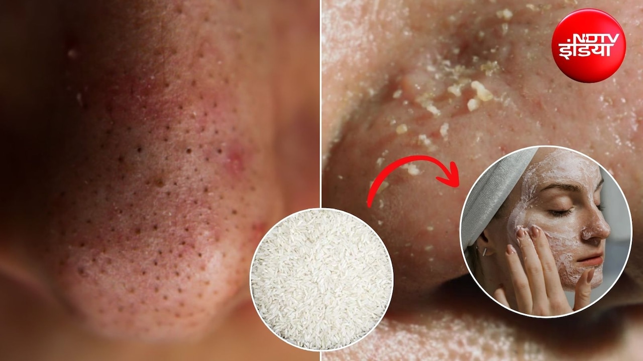 Home Remedy: ब्लैकहेड्स और व्हाइटहेड्स से पाना है छुटकारा? घर पर बनाकर लगाएं चावल का ये स्क्रब, जान लें तरीका