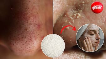 Home Remedy: ब्लैकहेड्स और व्हाइटहेड्स से पाना है छुटकारा? घर पर बनाकर लगाएं चावल का ये स्क्रब, जान लें तरीका
