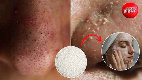 Home Remedy: ब्लैकहेड्स और व्हाइटहेड्स से पाना है छुटकारा? घर पर बनाकर लगाएं चावल का ये स्क्रब, जान लें तरीका