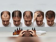 बाल झड़ने से पहले शरीर देता है ये 5 संकेत, समय रहते पहचानेंगे तो बच सकता है गंजापन