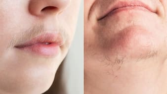 Upper Lips और ठुड्डी के बालों को कम कैसे करें? एक्सपर्ट ने बताया लड़कियों के लिए सबसे असरदार तरीका