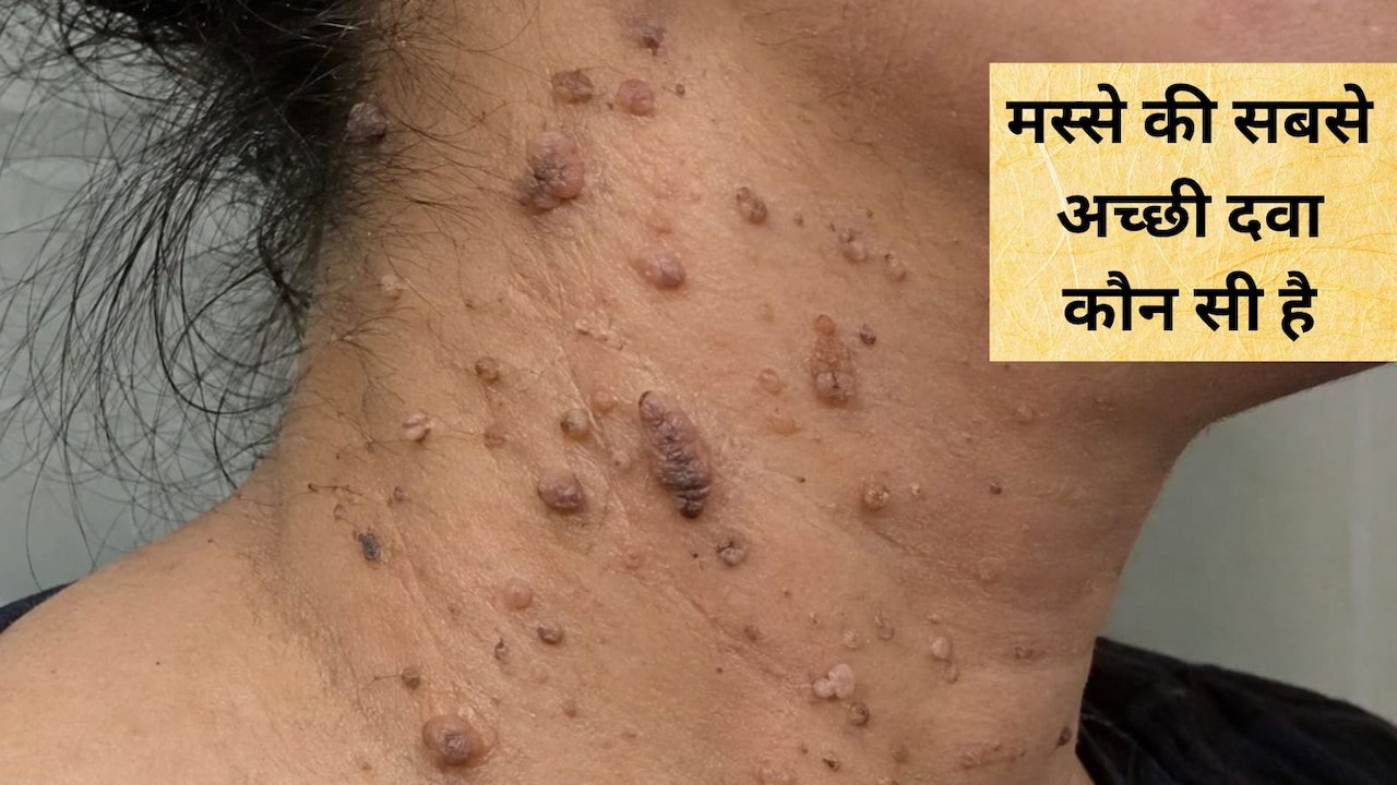मस्से को जड़ से खत्म करने के लिए क्या करें? आयुर्वेदाचार्य ने कहा घर में यूं बना लें मस्‍सा खत्‍म करने वाली दवाई