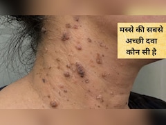 मस्से को जड़ से खत्म करने के लिए क्या करें? आयुर्वेदाचार्य ने कहा घर में यूं बना लें मस्‍सा खत्‍म करने वाली दवाई