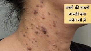 मस्से को जड़ से खत्म करने के लिए क्या करें? आयुर्वेदाचार्य ने कहा घर में यूं बना लें मस्&zwj;सा खत्&zwj;म करने वाली दवाई