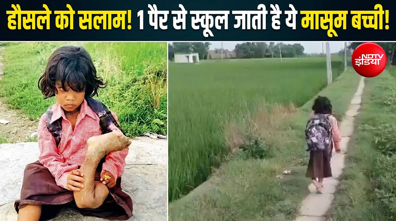 डॉक्टर बनने का सपना, एक पैर से स्कूल का सफर... बलिया की बच्ची का वीडियो भावुक कर देगा