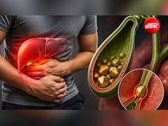 पित्त की थैली में पथरी के क्या लक्षण होते हैं?