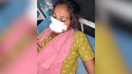 Telangana Man Bites Off Wife's Nose After She Refuses To Return Home