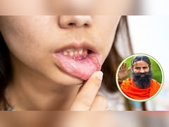 मुंह में छाला हो जाए तो क्या लगाएं? बाबा रामदेव ने बताया ये पेस्ट लगाने से एक बार में ही दब जाएगा