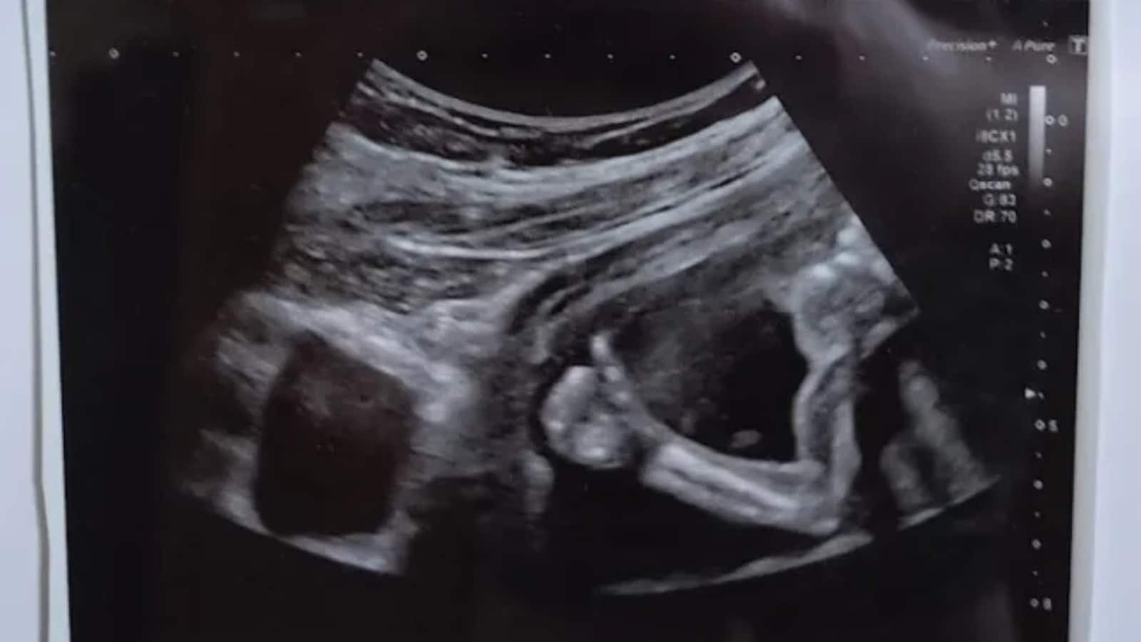 Doctors suggested abortion Unborn baby thumbs up womb Medical Miracle Chloe Ruker Daisy