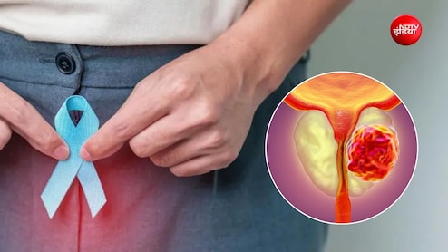 प्रोस्टेट कैंसर का पता चलने पर क्या तुरंत सर्जरी जरूरी है? जानें इलाज के विकल्प&nbsp;