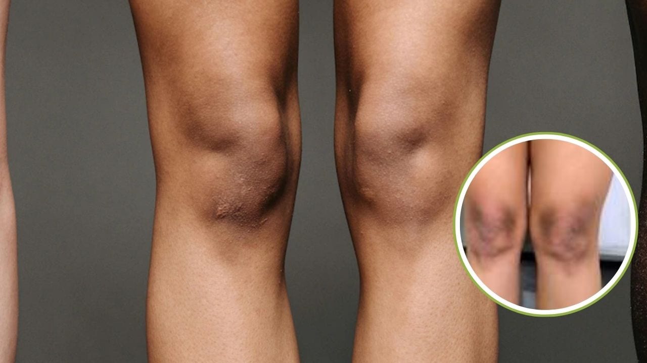 Dark Knees: घुटनों का कालापन कैसे कम करें? स्किन एक्सपर्ट ने बताया घुटनों की डार्कनेस कम करने के लिए क्या लगाना चाहिए