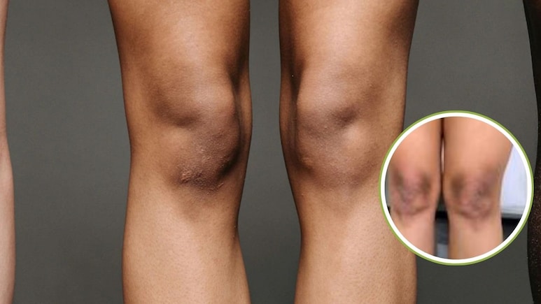 Dark Knees: घुटनों का कालापन कैसे कम करें? स्किन एक्सपर्ट ने बताया घुटनों की डार्कनेस कम करने के लिए क्या लगाना चाहिए