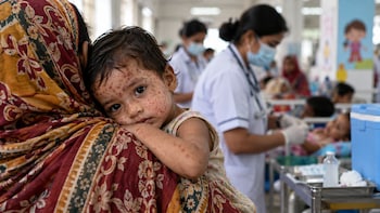Bangladesh Measles Outbreak: 1,012 Deaths, 1.89 Lakh Cases Reported