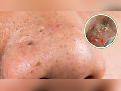 चेहरे के ब्लैकहेड्स कैसे साफ करें? स्किन एक्सपर्ट ने बताए 3 सबसे असरदार तरीके