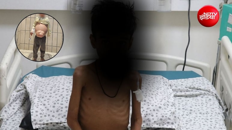 3 साल तक डॉक्टर समझते रहे दूसरी बीमारी, जेनेटिक टेस्ट से खुला राज, 5 साल के बच्चे को मिली नई जिंदगी