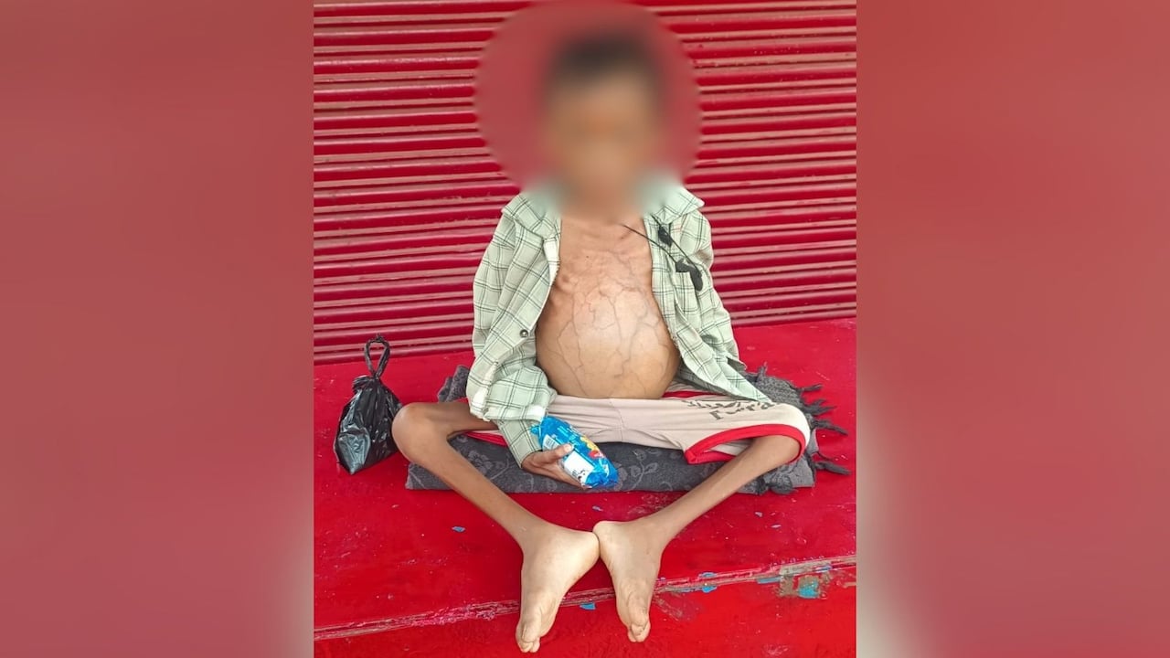 After 7-Year-Old Child's Death In Madhya Pradesh, Family's Malnutrition Charge