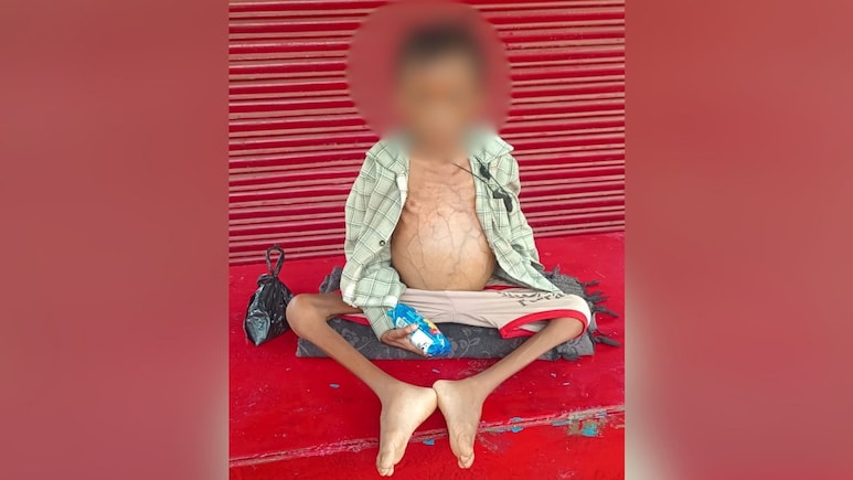 After 7-Year-Old Child's Death In Madhya Pradesh, Family's Malnutrition Charge