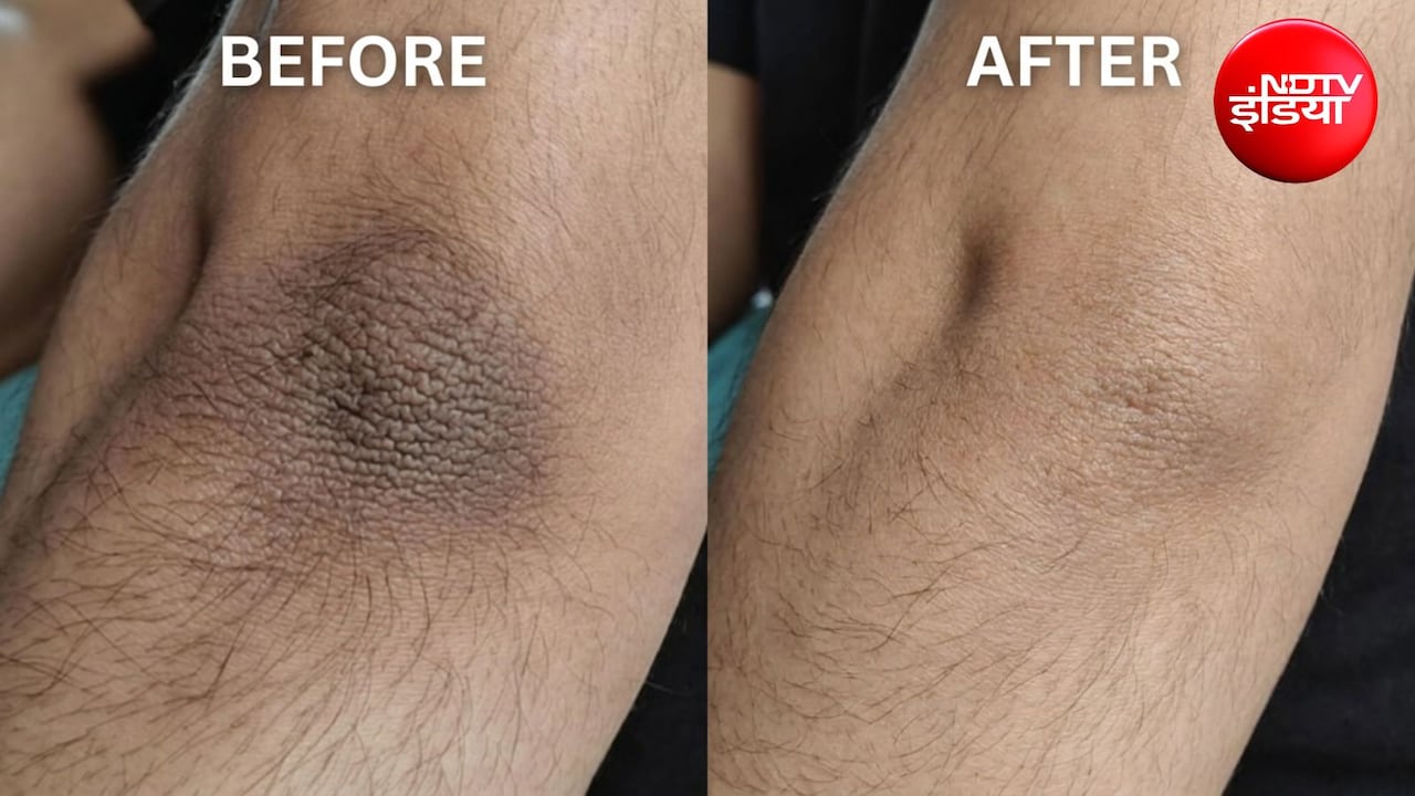 DIY Scrub: मैल से कोहनी और घुटने दिखने लगे काले? अपनाएं ये 3 होममेड स्क्रब, साफ हो जाएगी स्किन, चमकेगी त्वचा