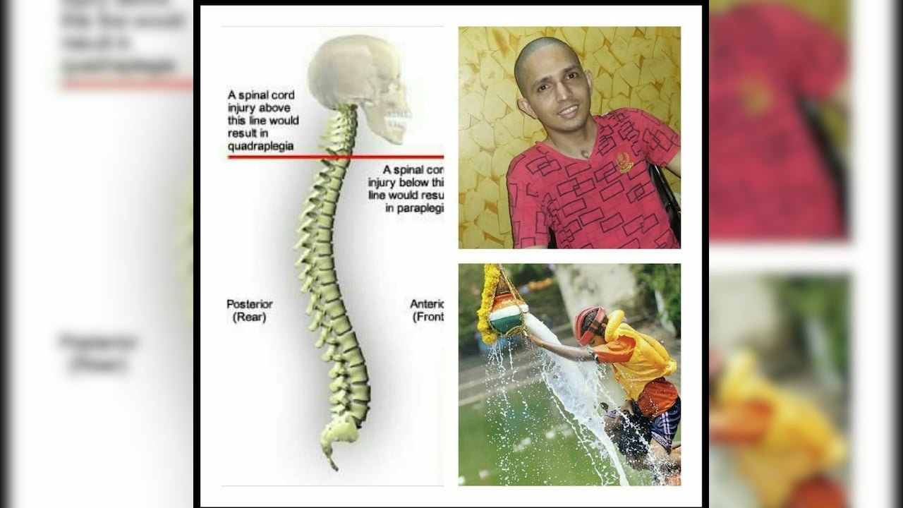 Nagesh suffered a spinal injury Nagesh suffered a spinal injury