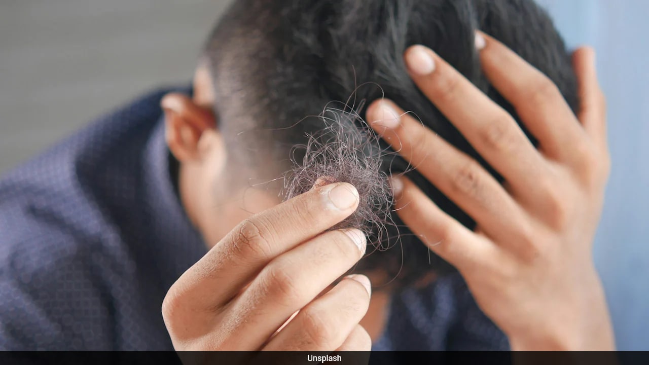 Arthritis drug upadacitinib shows hair regrowth in severe alopecia areata trials