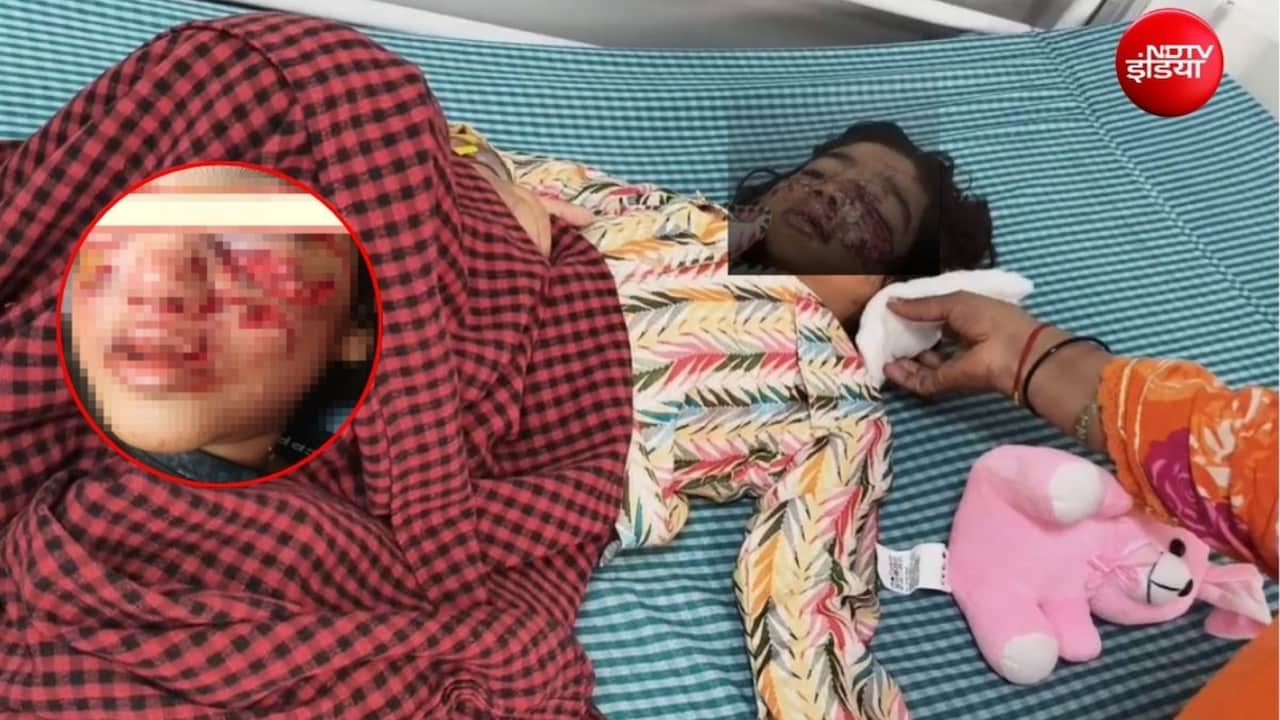 बिल्ली को बचाने कुत्ते से‍ भिड़ी 4 साल की मासूम, उसने बुरी तरह नोंचा, बहन की हिम्मत से बची जान, चेहरे पर जख्म