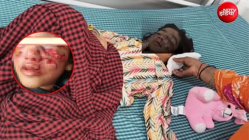 बिल्ली को बचाने कुत्ते से&zwj; भिड़ी 4 साल की मासूम, उसने बुरी तरह नोंचा, बहन की हिम्मत से बची जान, चेहरे पर जख्म