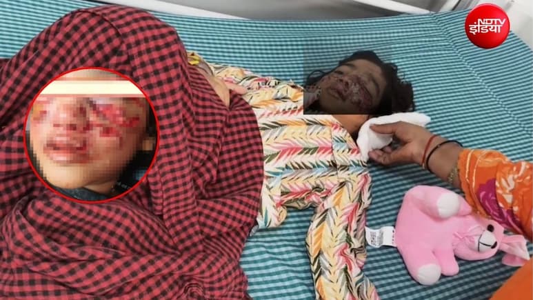 बिल्ली को बचाने कुत्ते से&zwj; भिड़ी 4 साल की मासूम, उसने बुरी तरह नोंचा, बहन की हिम्मत से बची जान, चेहरे पर जख्म