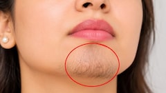 ठुड्डी पर बाल आना कैसे कम करें? एक्सपर्ट ने बताए 2 असरदार तरीके