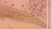 Korean Farmer Goes For Eye Checkup, Doctors Discover 11 Parasitic Worms