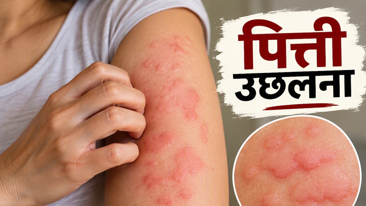Pitti Ka Gharelu Ilaj: शरीर पर पित्ती उछलने के घरेलू उपाय, यूनानी एक्सपर्ट ने बताया क्‍या खाएं, क्‍या नहीं