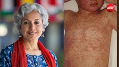 क्या लौट आया है खसरा? WHO की पूर्व चीफ ने बताया क्यों वैक्सीनेशन के बावजूद तेजी से बढ़ रहे हैं मामले