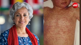 क्या लौट आया है खसरा? WHO की पूर्व चीफ ने बताया क्यों वैक्सीनेशन के बावजूद तेजी से बढ़ रहे हैं मामले