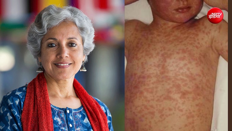 क्या लौट आया है खसरा? WHO की पूर्व चीफ ने बताया क्यों वैक्सीनेशन के बावजूद तेजी से बढ़ रहे हैं मामले