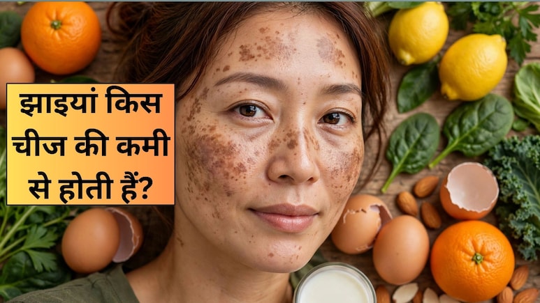 किस विटामिन की कमी से झाइयां होती है, कौन से फूड्स खाने से दूर होगी ये कमी