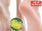 फटी एड़ी कैसे ठीक करें? रातों-रात फटे पैरों को कैसे ठीक करें, जान‍िए होम रेमेडी एक्‍सपर्ट से