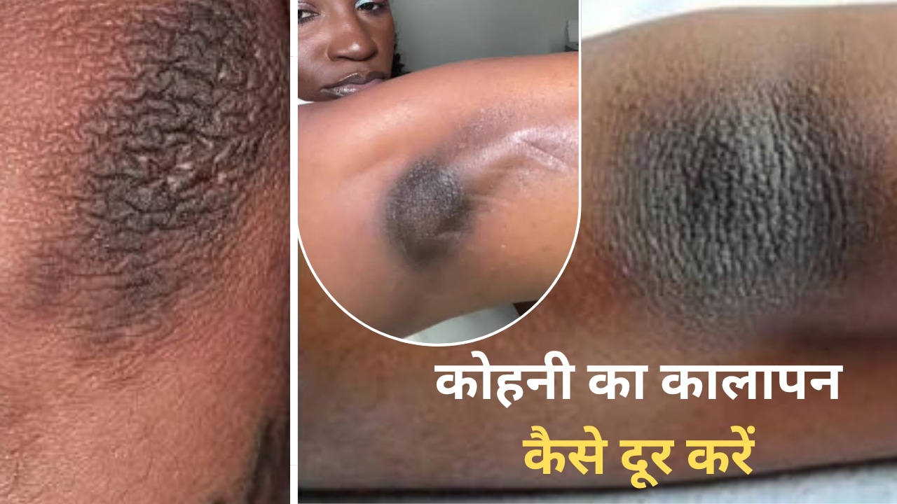 कोहनी काली पड़ गई है? चमकाने के चक्कर में ये गलती न करें, जानें कैसे दूर करें कोहनी का कालापन?