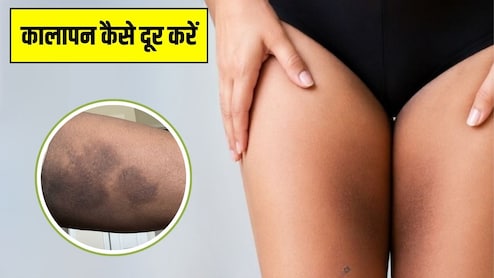 जांघों के बीच में कालापन कैसे दूर करें? स्किन एक्सपर्ट ने बताई थाइज का कालापन दूर करने की दवा