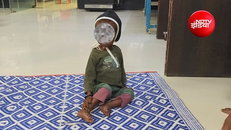 धार में कुपोषण की मार: 25 हजार बच्चे कुपोषित, 5 हजार से ज्यादा अति गंभीर श्रेणी में; पोषण व्यवस्था पर उठे सवाल