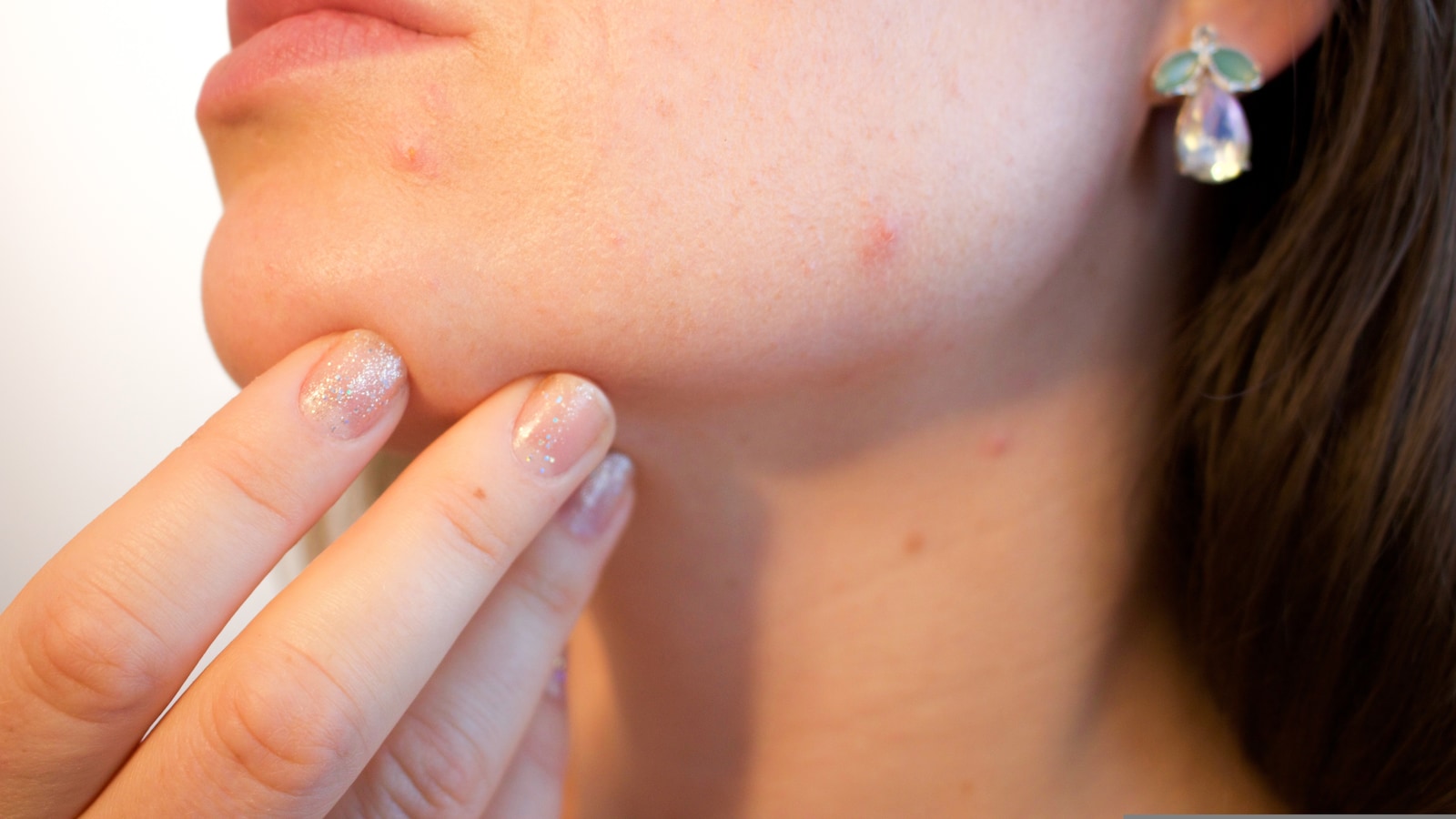 How Pimple Popping And Blackhead Removal Videos Are Becoming The New ASMR