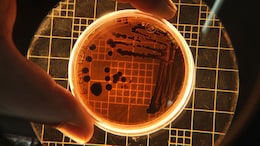 Plague Is A Bacterial Infection: Bubonic, Pneumonic And Septicemic Plague Types Explained