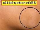 बच्‍चे के चेहरे पर सफेद दाग क्यों होते हैं? स्किन एक्सपर्ट ने बताया जगह-जगह ऐसे सफेद धब्बे दिखें, तो क्या करें
