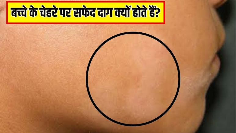 बच्&zwj;चे के चेहरे पर सफेद दाग क्यों होते हैं? स्किन एक्सपर्ट ने बताया जगह-जगह ऐसे सफेद धब्बे दिखें, तो क्या करें
