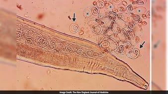Korean Farmer Goes For Eye Checkup, Doctors Discover 11 Parasitic Worms