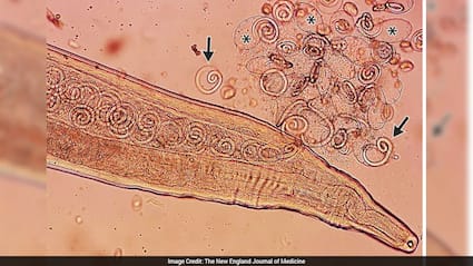 Korean Farmer Goes For Eye Checkup, Doctors Discover 11 Parasitic Worms
