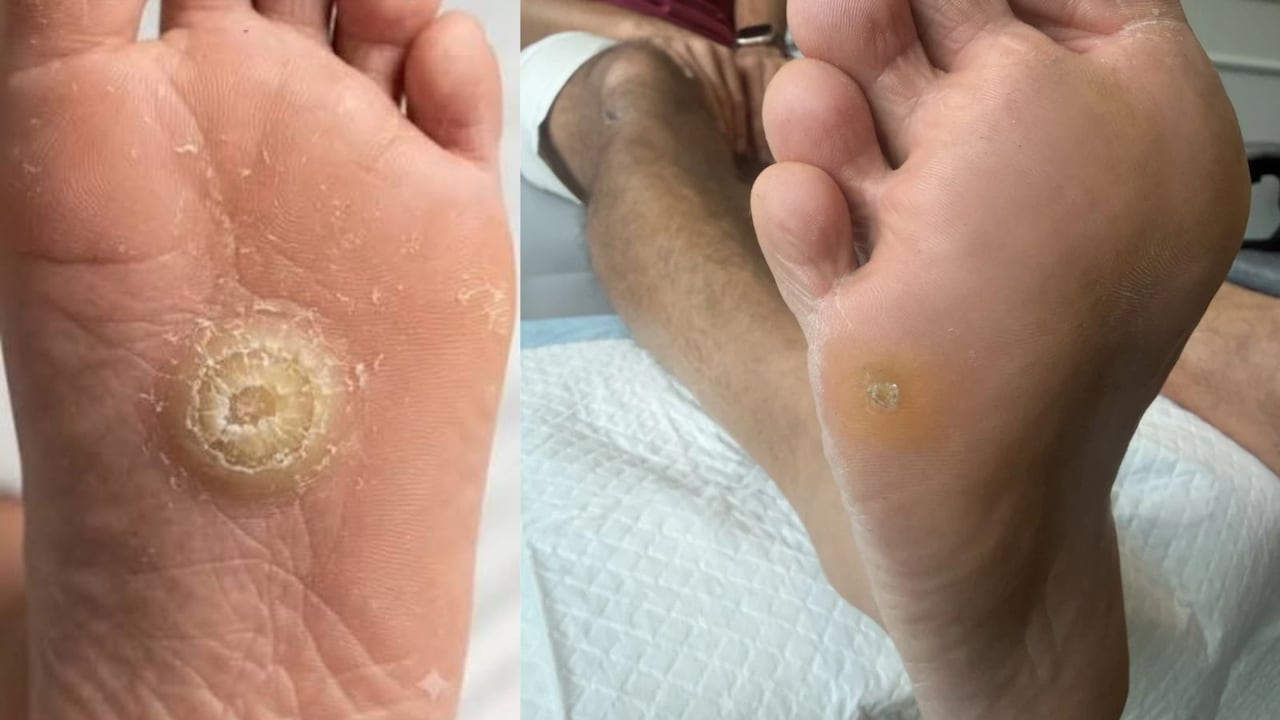 फुट कॉर्न (गोखरू) का घर बैठे करें इलाज, इन 5 कारणों से बढ़ती है ये समस्या