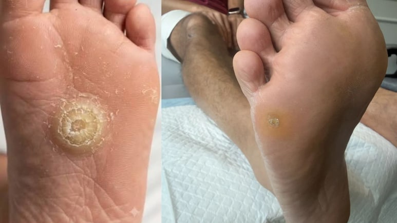 फुट कॉर्न (गोखरू) का घर बैठे करें इलाज, इन 5 कारणों से बढ़ती है ये समस्या